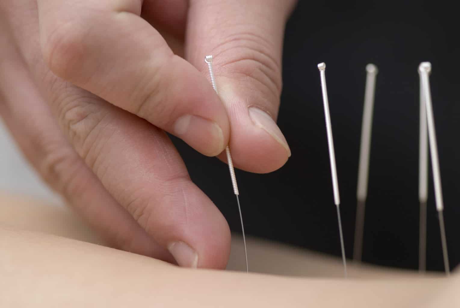 19 Top Acupuncture Schools In The World 2026 Salary Excelsior